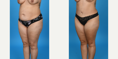 Case 10705 - 35-44 year old woman treated with Abdominal Etching, Diastasis Recti Repair, Drainless Tummy Tuck, Liposculpture, Liposuction, T