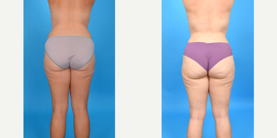 Case 10706 - 35-44 year old woman treated with Abdominal Etching, Diastasis Recti Repair, Drainless Tummy Tuck, Liposculpture, Liposuction, M