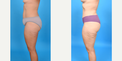 Case 10708 - 35-44 year old woman treated with Abdominal Etching, Diastasis Recti Repair, Drainless Tummy Tuck, Liposculpture, Liposuction, M