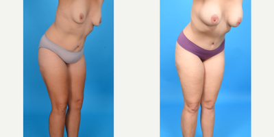 Case 10710 - 35-44 year old woman treated with Abdominal Etching, Diastasis Recti Repair, Drainless Tummy Tuck, Liposculpture, Liposuction, M