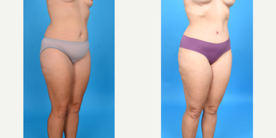 Case 10711 - 35-44 year old woman treated with Abdominal Etching, Diastasis Recti Repair, Drainless Tummy Tuck, Liposculpture, Liposuction, M