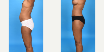 Case 10712 - 45-54 year old woman treated with Abdominal Etching, Tummy Tuck, Mini Tummy Tuck, Drainless Tummy Tuck, Vaser Liposuction, Mommy