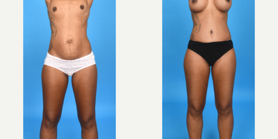 Case 10718 - 45-54 year old woman treated with Abdominal Etching, Tummy Tuck, Mini Tummy Tuck, Drainless Tummy Tuck, Vaser Liposuction, Mommy