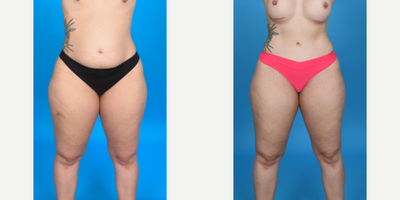 Case 10721 - 35-44 year old woman treated with Tummy Tuck, Diastasis Recti Repair, Mini Tummy Tuck, Drainless Tummy Tuck, Liposculpture, Lipo