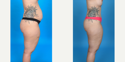 Case 10723 - 35-44 year old woman treated with Tummy Tuck, Diastasis Recti Repair, Mini Tummy Tuck, Drainless Tummy Tuck, Liposculpture, Lipo