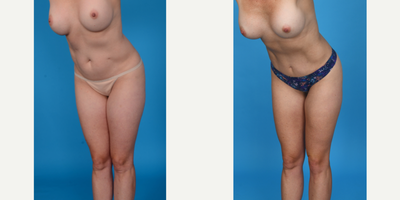 Case 10726 - 35-44 year old woman treated with Abdominal Etching, Belly Button Surgery, Diastasis Recti Repair, Drainless Tummy Tuck, Liposcu