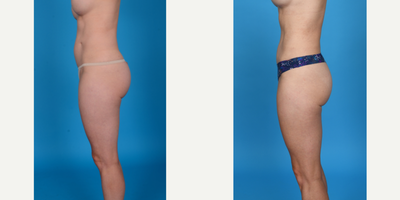 Case 10728 - 35-44 year old woman treated with Abdominal Etching, Belly Button Surgery, Diastasis Recti Repair, Drainless Tummy Tuck, Liposcu