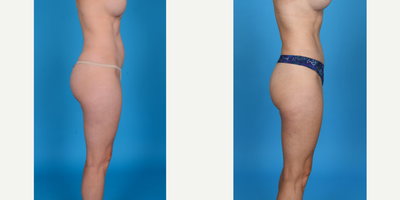 Case 10729 - 35-44 year old woman treated with Abdominal Etching, Belly Button Surgery, Diastasis Recti Repair, Drainless Tummy Tuck, Liposcu