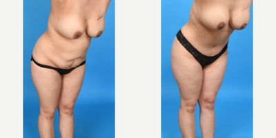 Case 10733 - 35-44 year old woman treated with Abdominal Etching, Diastasis Recti Repair, Drainless Tummy Tuck, Liposculpture, Liposuction, M