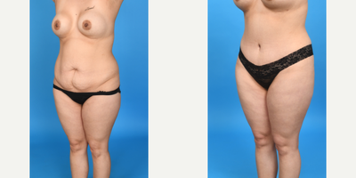 Case 10735 - 35-44 year old woman treated with Abdominal Etching, Diastasis Recti Repair, Drainless Tummy Tuck, Liposculpture, Liposuction, M