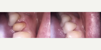 Case: 10737 - before and after photo of Patient treated with Dental Crown by Patricia Moezinia, DDS