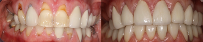 Case: 10738 - before and after photo of 55-64 year old woman treated with Dental Crown by Matt Annese, DMD