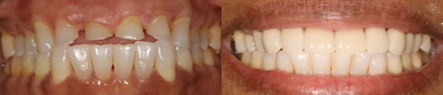 Case: 10739 - before and after photo of 45-54 year old woman treated with Dental Crown by Matt Annese, DMD