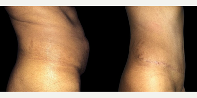 Case 1074 - Woman treated with Tummy Tuck