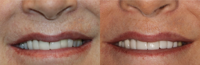 Case: 10740 - before and after photo of 45-54 year old woman treated with Dental Crown by Matt Annese, DMD