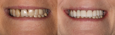 Case: 10741 - before and after photo of 45-54 year old woman treated with Dental Crown by Matt Annese, DMD