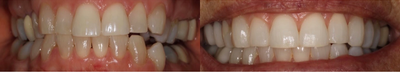 Case: 10742 - before and after photo of 55-64 year old woman treated with Dental Crown by Matt Annese, DMD