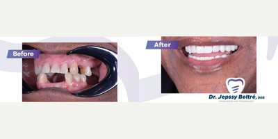 Case: 10743 - before and after photo of 65-74 year old man treated with Dental Crown by Jepssy Beltre, DDS