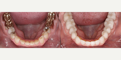 Case: 10744 - before and after photo of 35-44 year old woman treated with Dental Crown by Anthony Mobasser, DDS, DMD