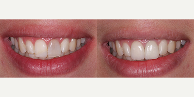 Case: 10745 - before and after photo of 35-44 year old woman treated with Dental Crown by Anthony Mobasser, DDS, DMD