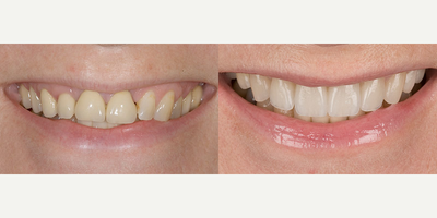 Case 10746 - 45-54 year old woman treated with Dental Crown