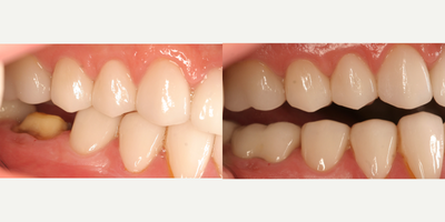 Case 10747 - 65-74 year old man treated with Dental Crown