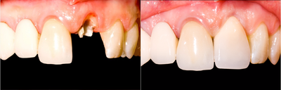 Case 10748 - Dental Crown Procedure Before and After