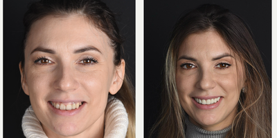 Case 10768 - 25-34 year old woman treated with Smile Makeover, Porcelain Veneers, Dental Crown