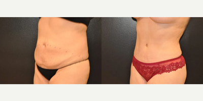 Case 1077 - Woman treated with Tummy Tuck