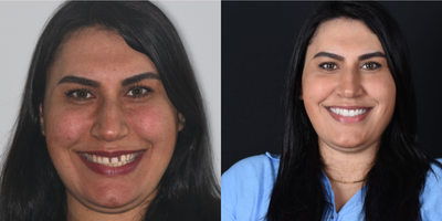 Case 10776 - 35-44 year old woman treated with Dental Crown, Smile Makeover, Lumineers, Dental Bridge, Porcelain Veneers