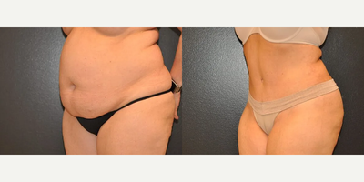 Case 1078 - Woman treated with Tummy Tuck