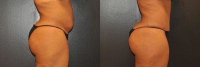 Case 1079 - Woman treated with Tummy Tuck