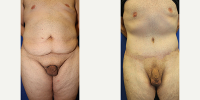 Case 108 - Man treated with Tummy Tuck
