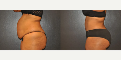 Case 1080 - Woman treated with Tummy Tuck