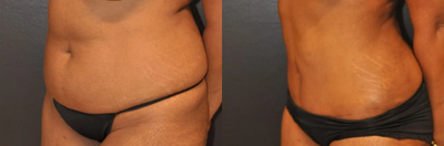 Case 1081 - Woman treated with Tummy Tuck