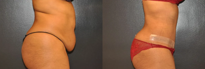 Case 1082 - Woman treated with Tummy Tuck