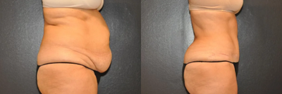 Case 1083 - Woman treated with Tummy Tuck