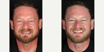 Case: 10836 - before and after photo of Man treated with Dental Implants by Scott Young, DDS