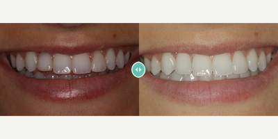 Case: 10837 - before and after photo of Woman treated with Dental Implants by Kathy Frazar, DDS, FAGD