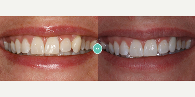Case: 10838 - before and after photo of Woman treated with Dental Implants by Kathy Frazar, DDS, FAGD