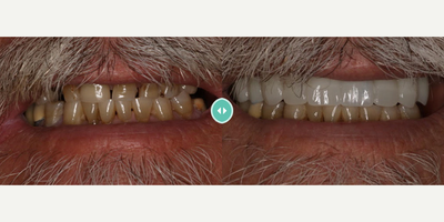 Case: 10839 - before and after photo of Man treated with Dental Implants by Kathy Frazar, DDS, FAGD