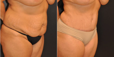 Case 1084 - Woman treated with Tummy Tuck