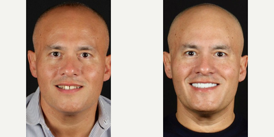 Case: 10840 - before and after photo of Man treated with Dental Implants by Scott Young, DDS