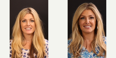 Case: 10841 - before and after photo of 35-44 year old woman treated with Porcelain Veneers, Dental Implants, Dental Bridge by Kathy Frazar, DDS, FAGD