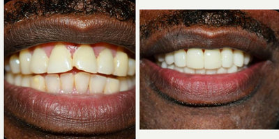 Case: 10842 - before and after photo of Man treated with Porcelain Veneers, Dental Implants by Jepssy Beltre, DDS