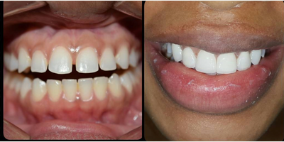 Case: 10843 - before and after photo of Man treated with Dental Implants, Porcelain Veneers by Jepssy Beltre, DDS
