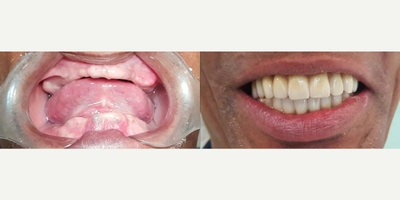 Case: 10844 - before and after photo of Man treated with All-on-4 Dental Implants, Dental Implants, Porcelain Veneers by Jepssy Beltre, DDS