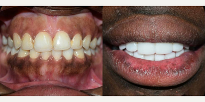 Case 10845 - Man treated with Porcelain Veneers, Dental Implants