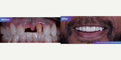 Case 10846 - 45-54 year old man treated with Dental Implants