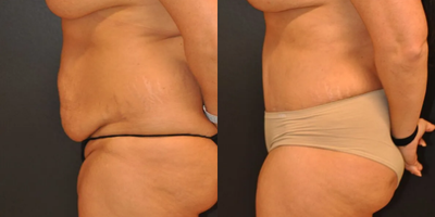 Case 1085 - Woman treated with Tummy Tuck